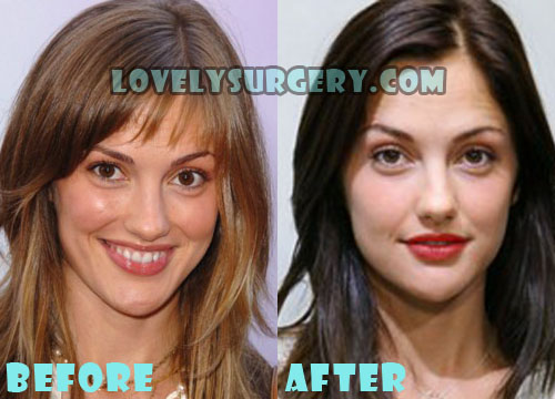 Minka Kelly Plastic Surgery