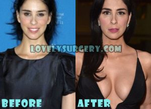 Sarah Silverman Plastic Surgery Boob Job