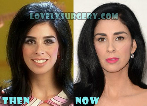 Sarah Silverman Plastic Surgery Botox, Fillers