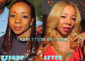Tameka Cottle Plastic Surgery Lip Injection