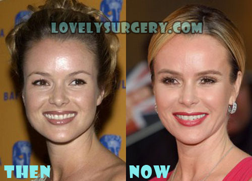 Amanda Holden Plastic Surgery Botox, Facelift Before After Photos
