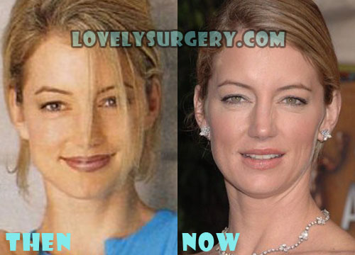 Cynthia Watros Plastic Surgery Botox