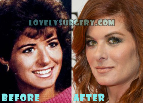 Debra Messing Plastic Surgery Before and After Pictures