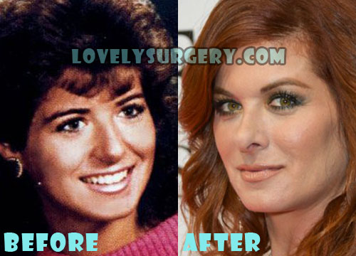 Debra Messing Plastic Surgery