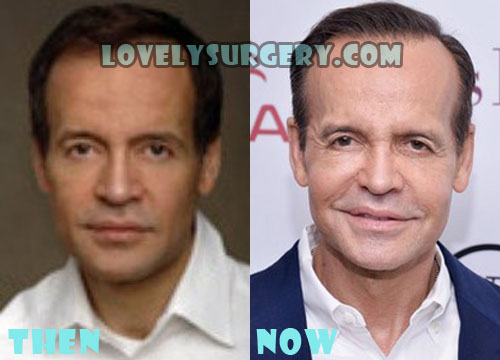 Louis Licari Plastic Surgery Botox, Facelift