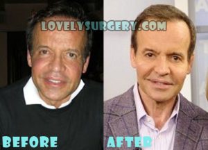 Louis Licari Plastic Surgery Lip Surgery