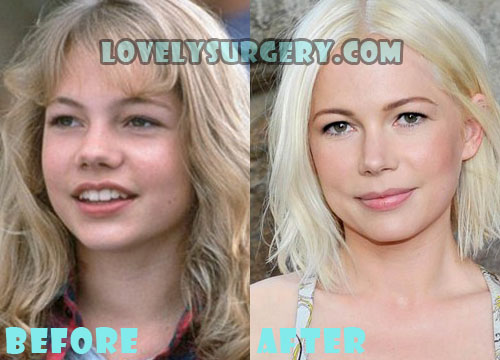 Michelle Williams Plastic Surgery Before and After Photos
