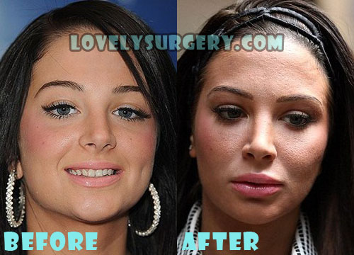 Tulisa Contostavlos Plastic Surgery Before and After Photos