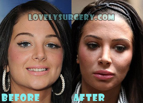 Tulisa Contostavlos Plastic Surgery