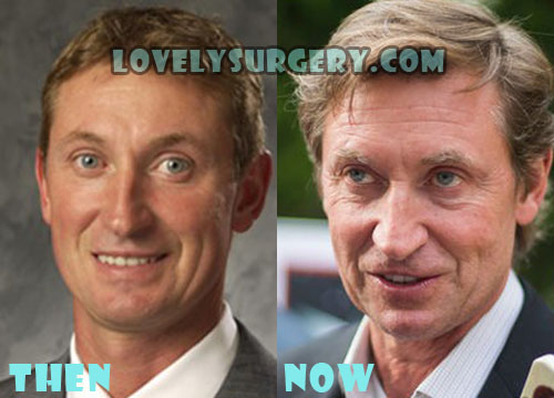 Wayne Gretzky Plastic Surgery Botox, Facelift