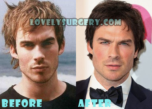 Ian Somerhalder Plastic Surgery Before and After Photo