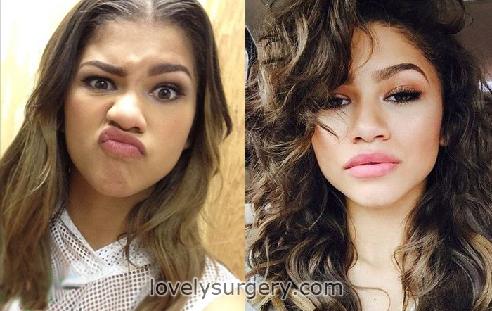 zendaya after plastic surgery