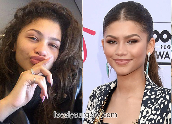 zendaya rhinoplasty