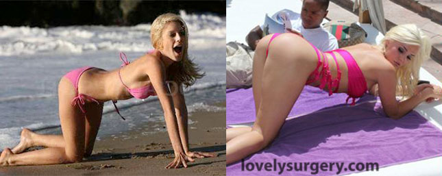Heidi Montag Before and After Plastic Surgery Ass
