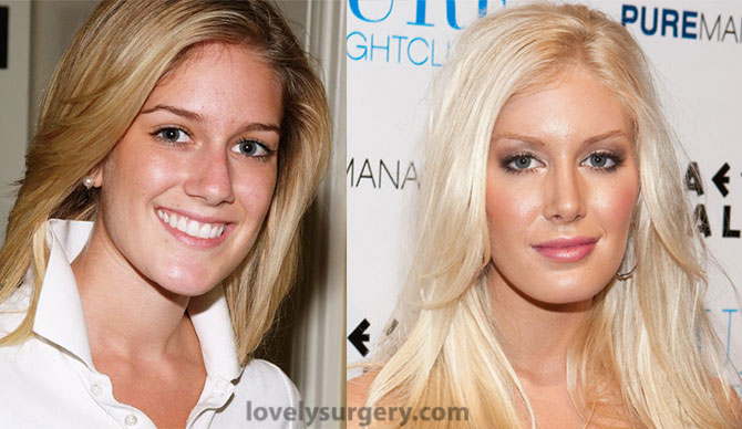 Heidi Montag Before and After Plastic Surgery