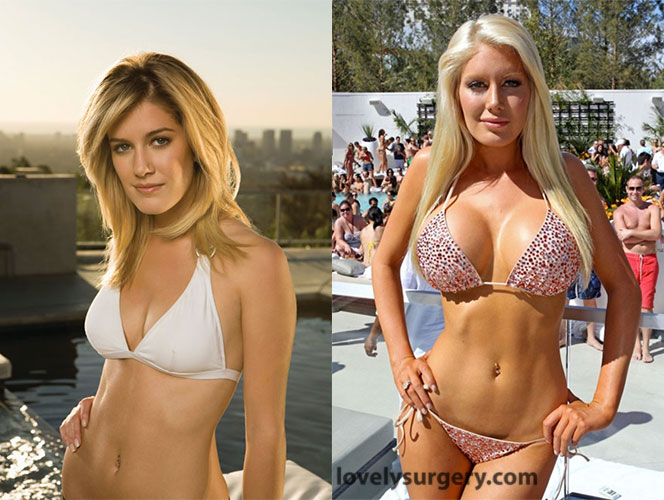 Heidi Montag Breast Operation Before and After.