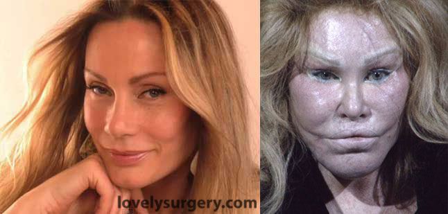 Jocelyn Wildenstein before and after plastic surgery