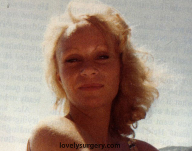 Jocelyn Wildensten before surgery