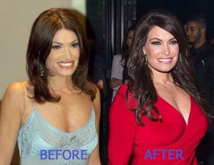 Kimberly Guilfoyle Breast Enhancement Before After
