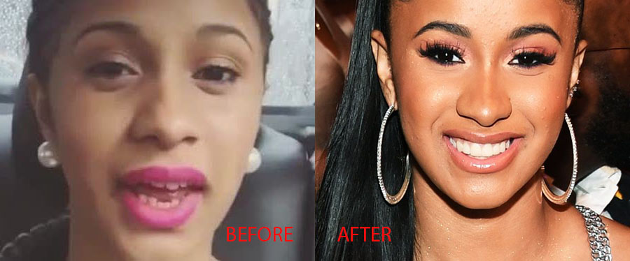 Cardi-B-Teeth-Before-After-Surgery - Lovely Surgery.