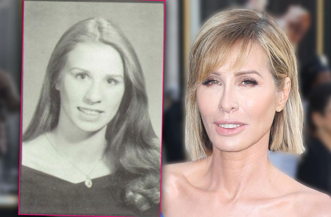 Carole Radziwill Plastic Surgery Procedures