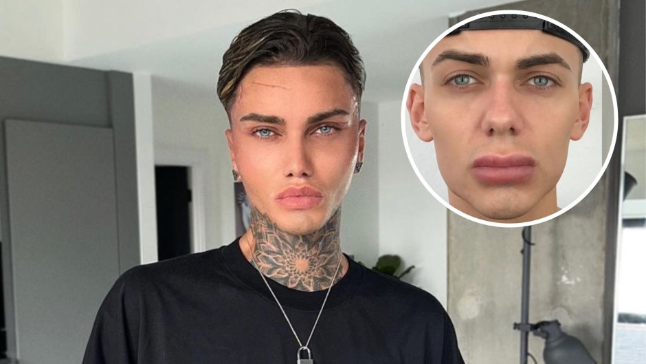 Levi Jed Murphy’s Journey Through Lip Fillers and Plastic Surgery